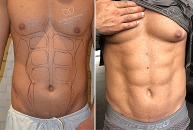 Six Pack Abs Tampa  BodySculpting Liposuction Clearwater