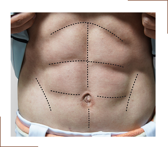 Six Pack Abs Surgery For Men Abdominal Liposuction Men