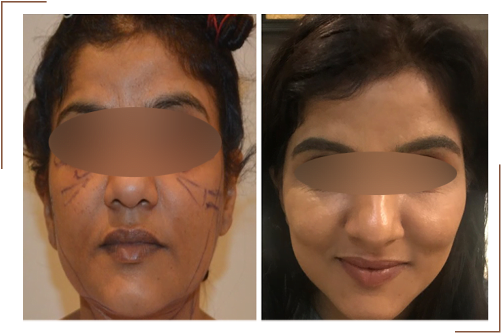 Best Facelift Surgery In Delhi Surgeon Price Dr Monisha Kapoor