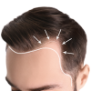 Direct Hairline Lowering