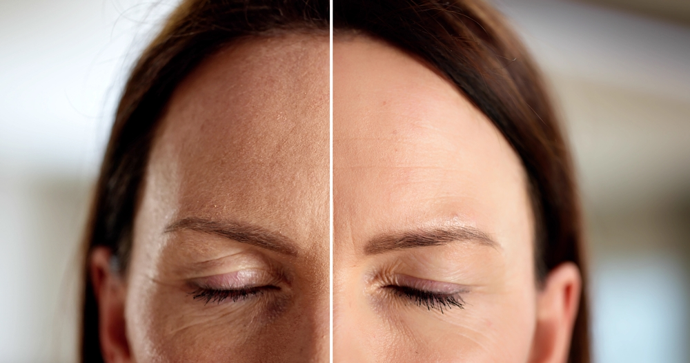 Benefits of Forehead Reduction