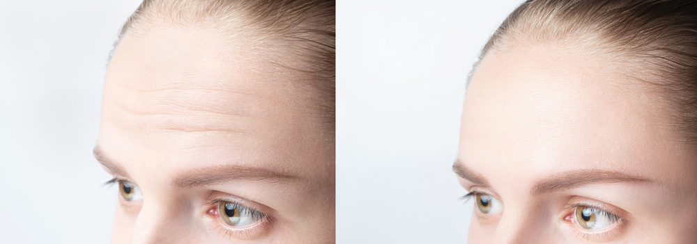Benefits of Forehead Reduction