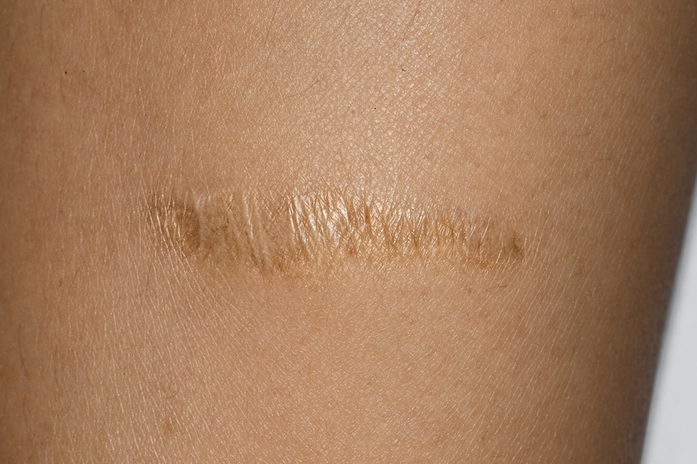 Hypertrophic Scars