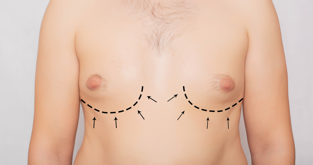 Tumescent Liposuction