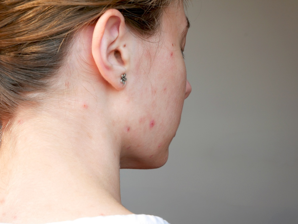 Acne Treatment