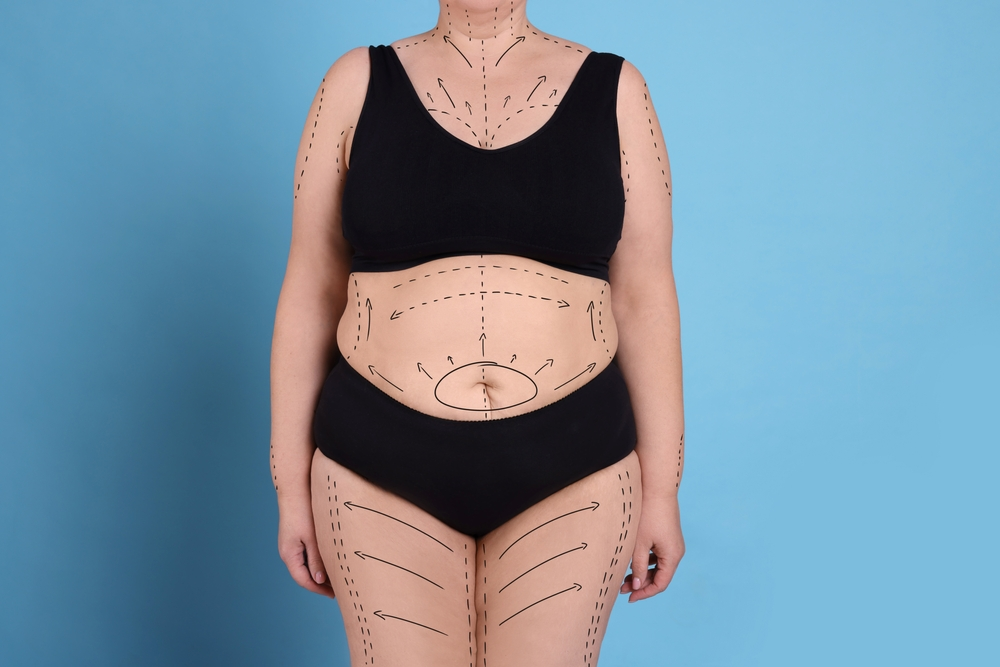 VASER Liposuction