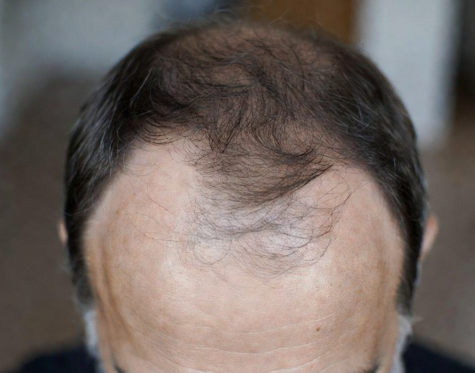 Understanding Hair Loss