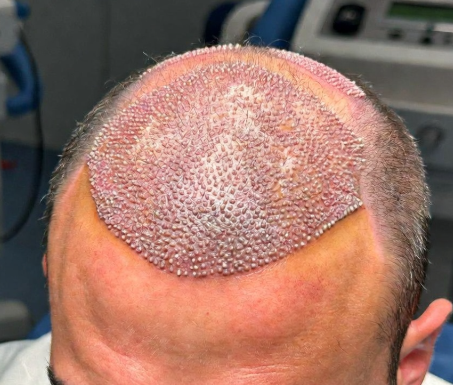 FUT Hair Transplant