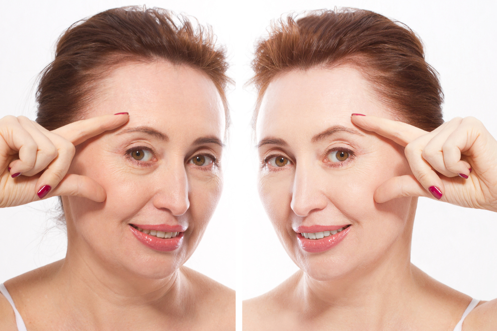 Mini Face Lift