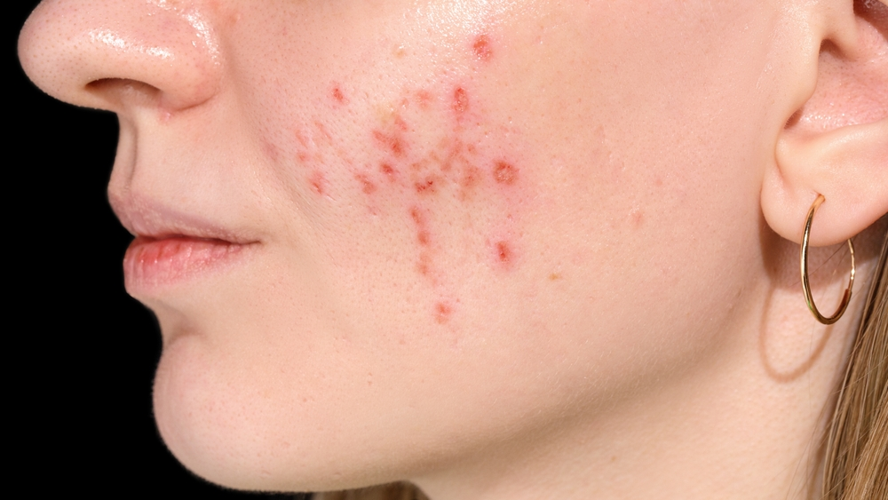 Ice Pick Scars