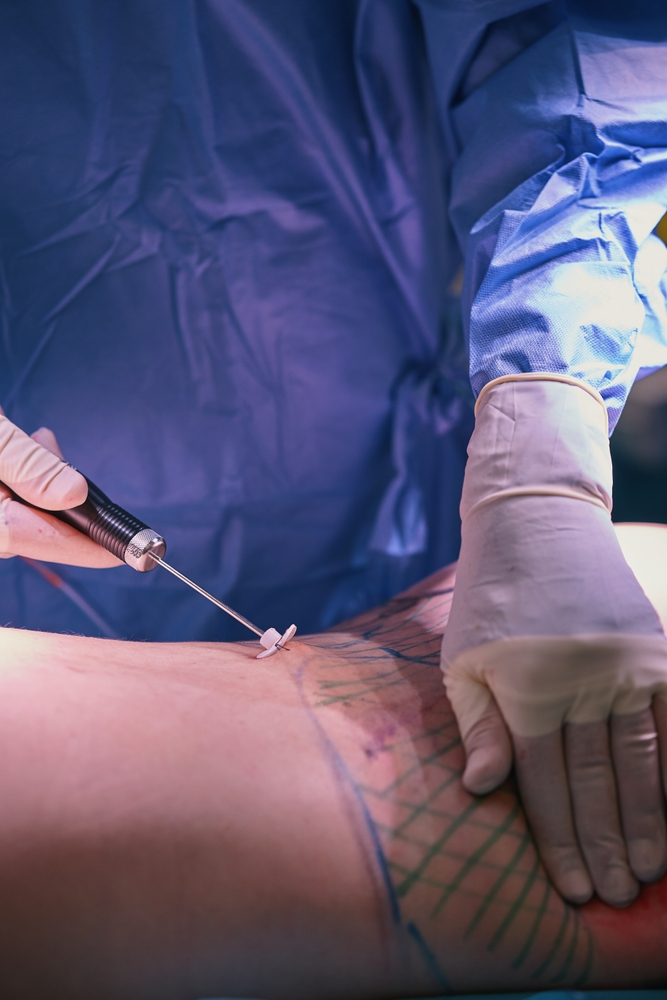 High-Definition Liposuction
