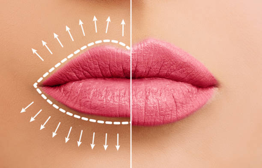 Lip Augumentation Surgery in Delhi