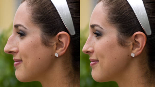Best Rhinoplasty Surgery in Delhi
