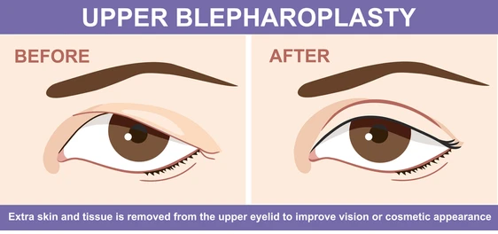 Upper Eyelid Surgery