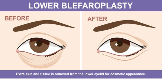 Lower Eyelid Surgery