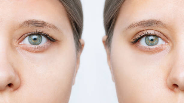Combined Eyelid Surgery