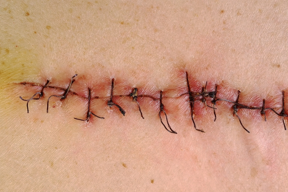 Incision Step