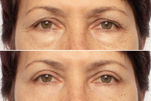 Benefits of Eyelid Surgery