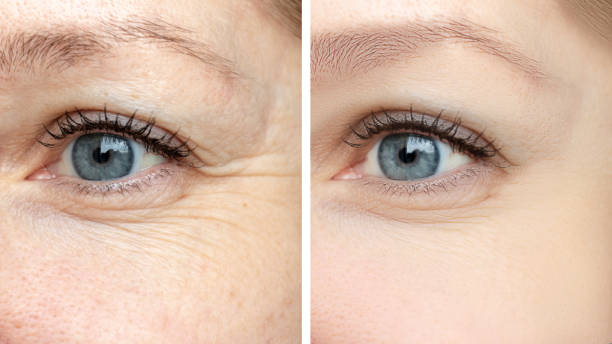 Eyelid Surgery Cost