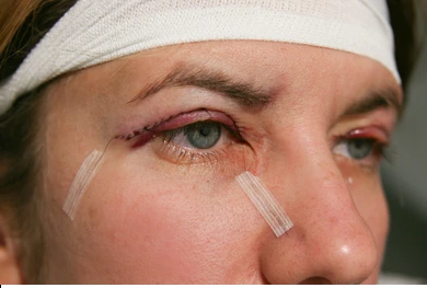 Recovery for Eyelid Surgery