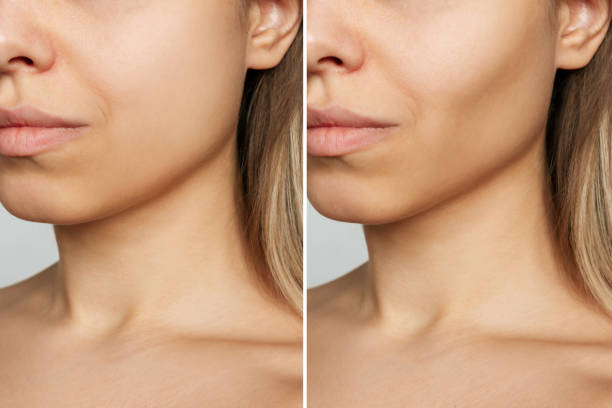Ideal Candidate for Cheek Implants