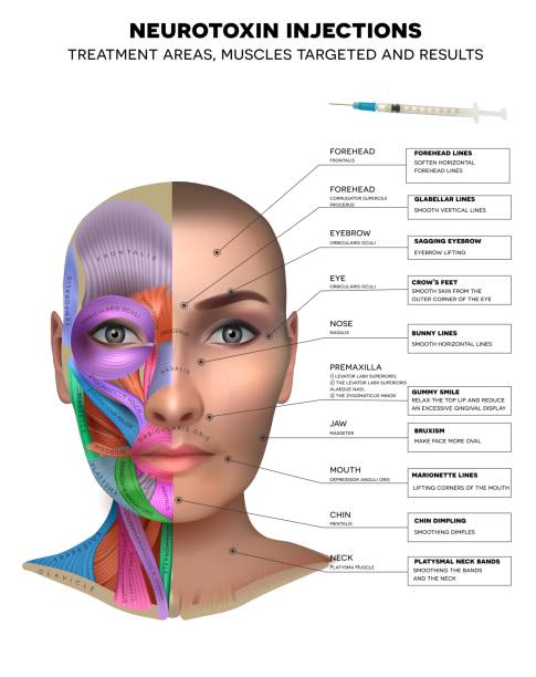 Neurotoxin Injection Areas