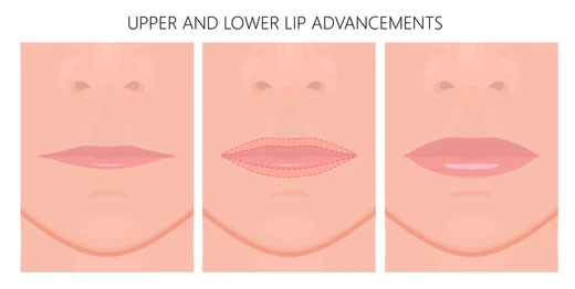 What Is Lip Augmentation Surgery?