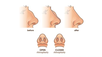 What Is Rhinoplasty Surgery?