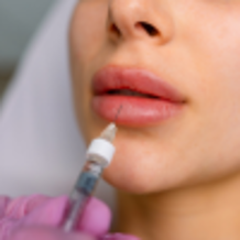 Lip Fillers