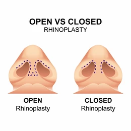 What Is Rhinoplasty Surgery?
