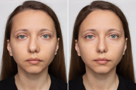 Benefits of Rhinoplasty Surgery