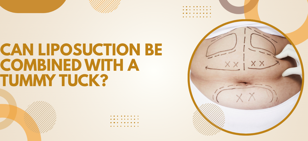 Liposuction for tummy tuck