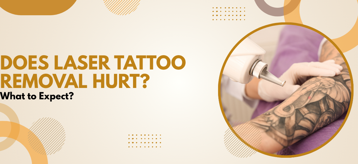 Laser Tattoo Removal