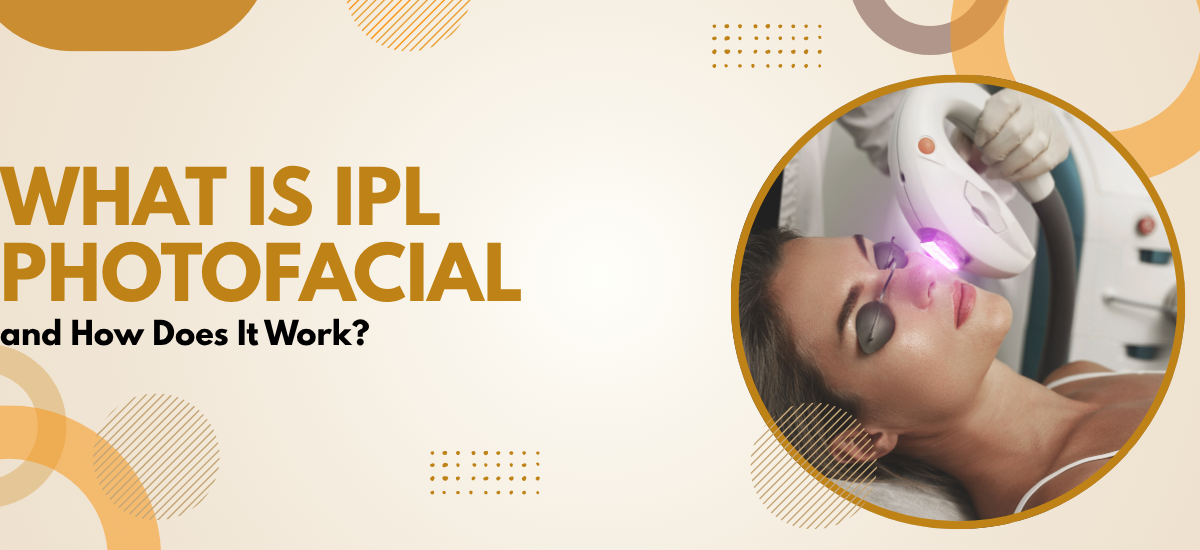 IPL Photofacial