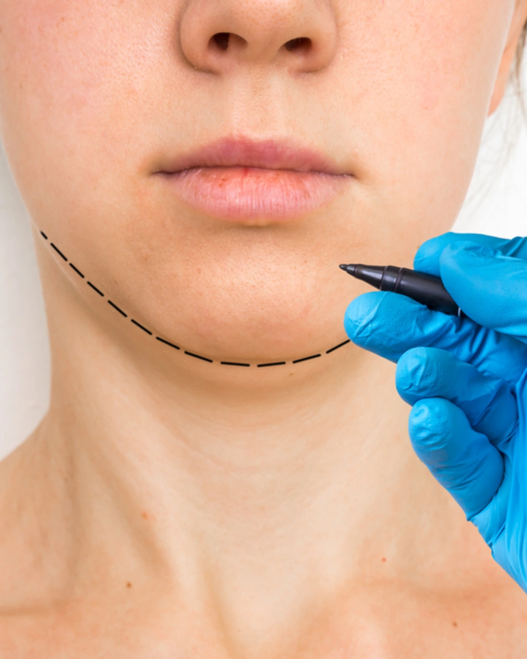 Jawline Reduction