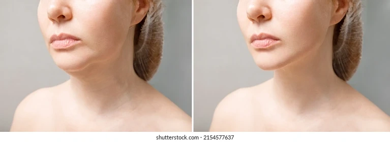 Benefits of Face Thinning Treatment