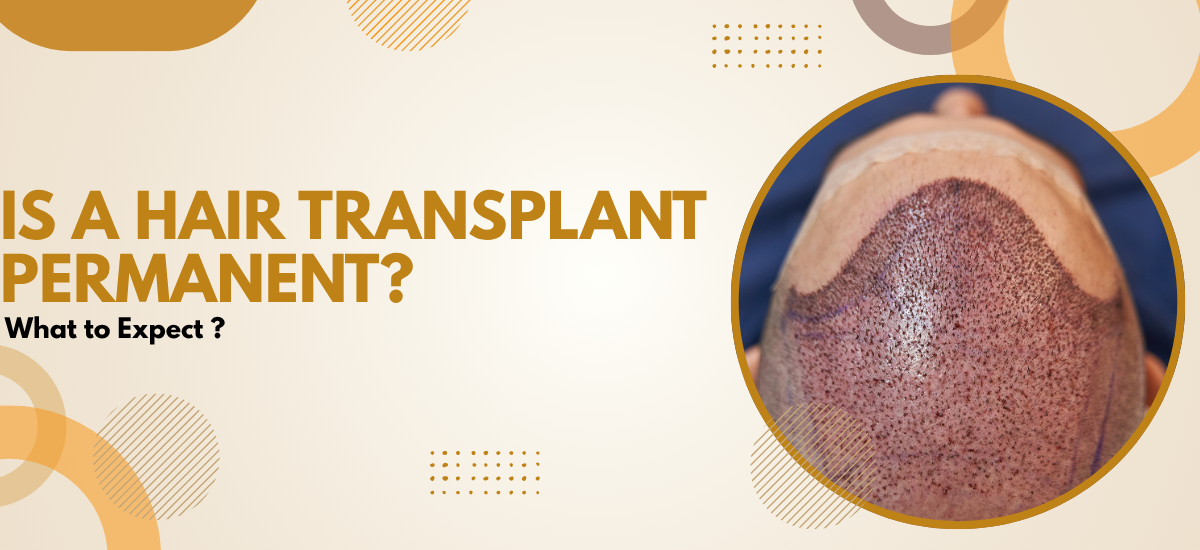 Hair Transplant Permanent