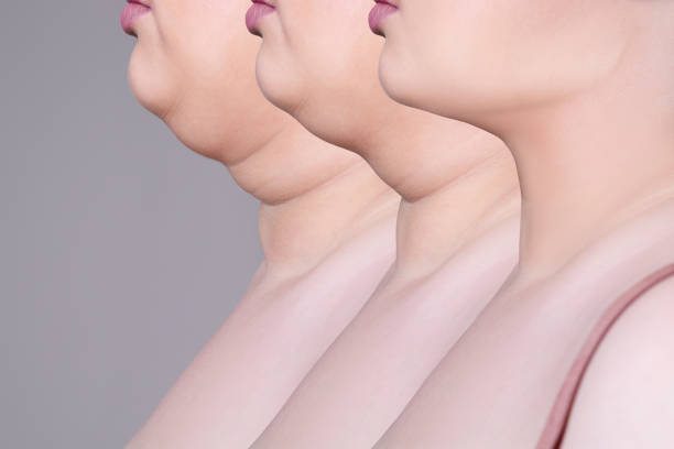 Double Chin Removal in Delhi