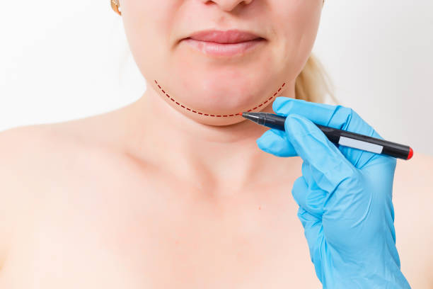 What Is Double Chin Removal?