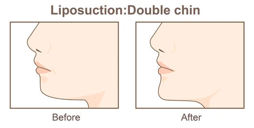 Chin Liposuction