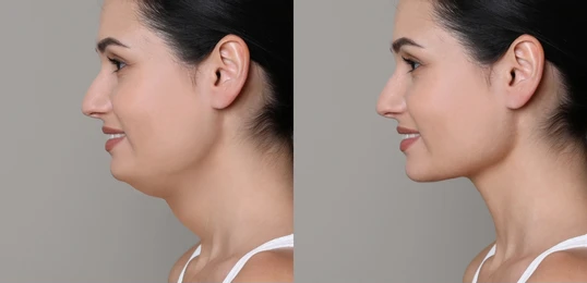 Benefits of Double Chin Removal