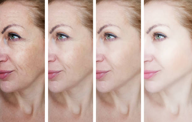 Benefits of Pellevé Skin Tightening Treatment