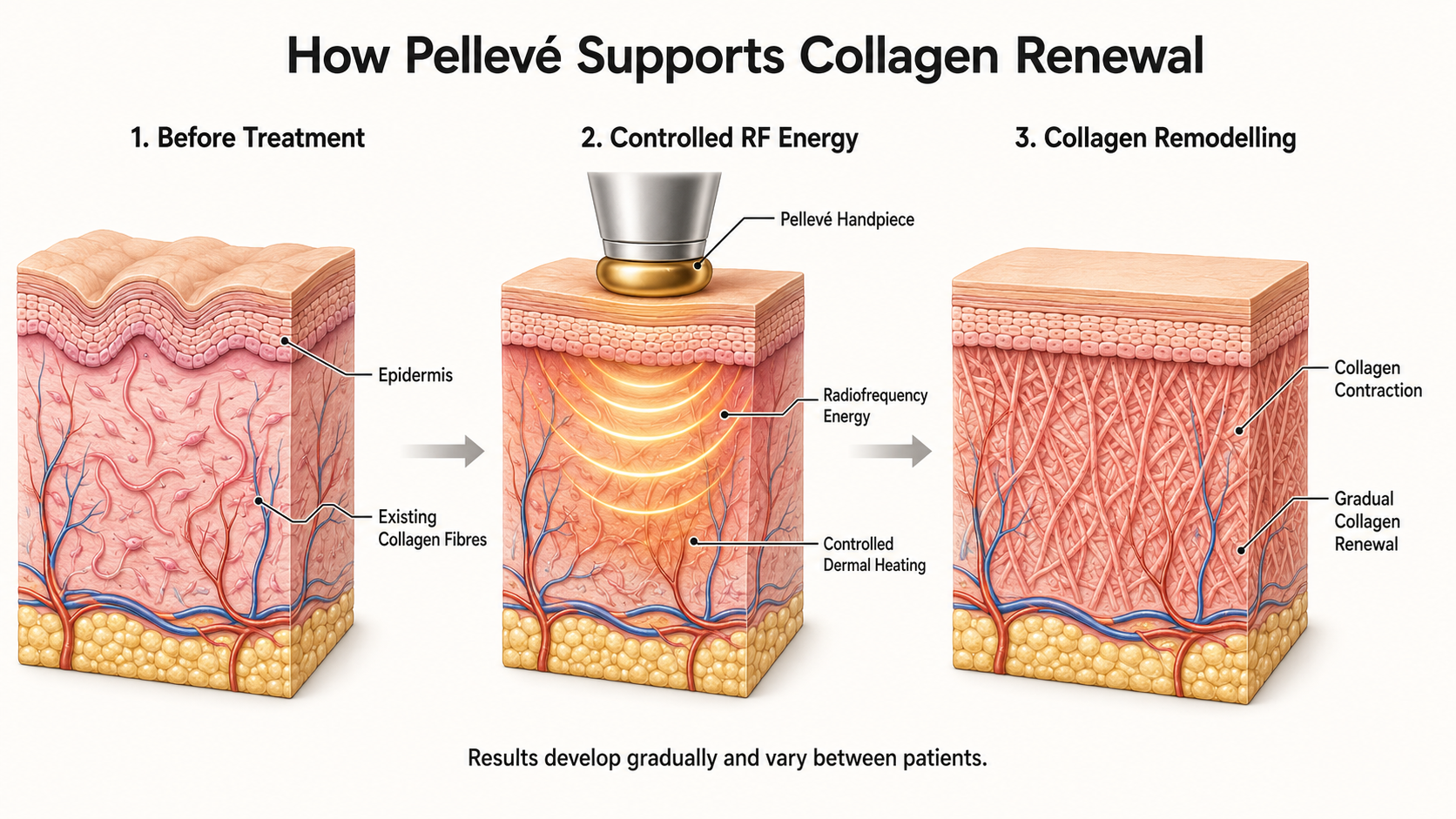 How Does Pellevé Skin Tightening Treatment Work?
