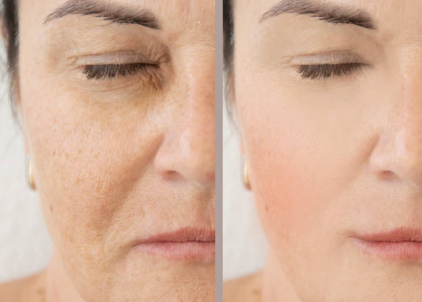 Skin Concerns Treated With Pellevé Skin Tightening