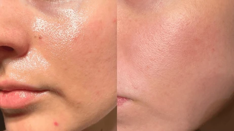 Acne & Oil-Control Protocol