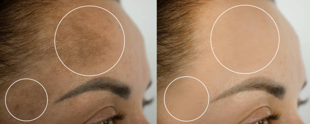 Pigmentation Protocol