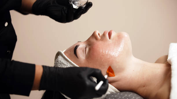 How Does Chemical Peel Treatment Work?