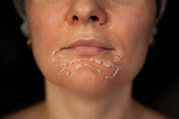 Benefits of Chemical Peel Treatment for Skin Rejuvenation