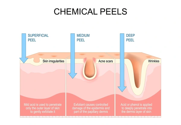 Skin Concerns Treated With Chemical Peel Treatment