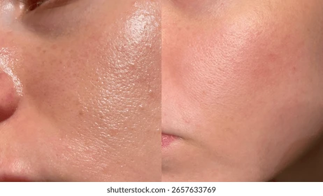 Benefits of Silk Peel Treatment for Skin Rejuvenation